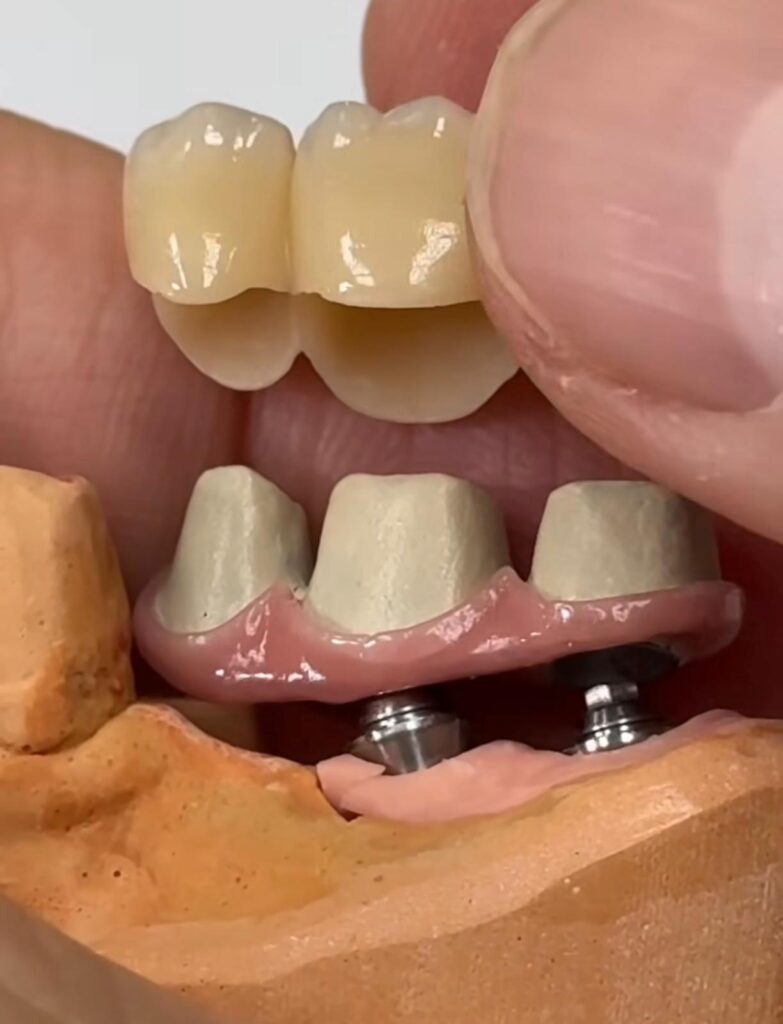 ZIRCONE MONOLITHIQUE